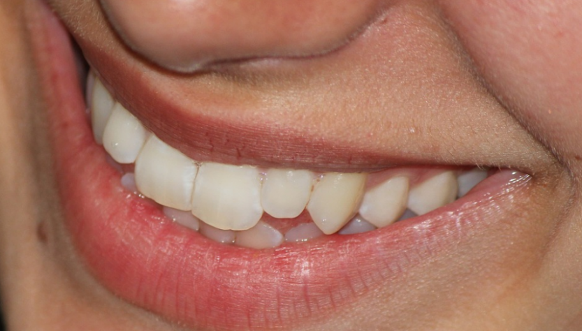 Pulizia Denti